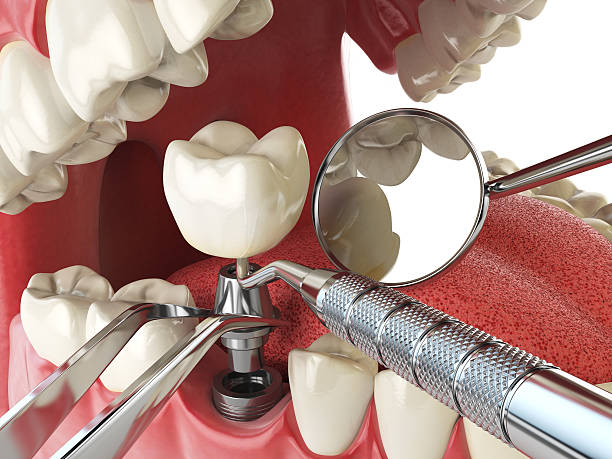 Best Emergency Root Canal Treatment in Mcewen, TN